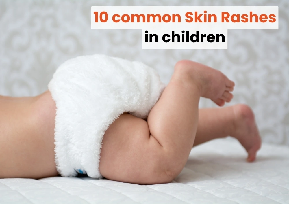 10 common skin rashes in children