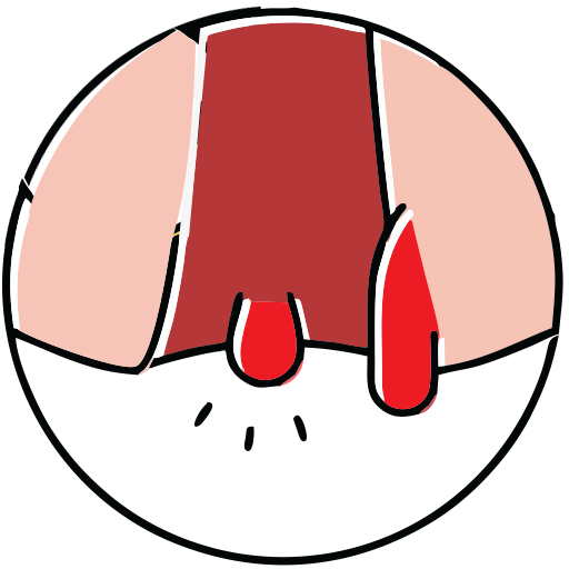 Fistula