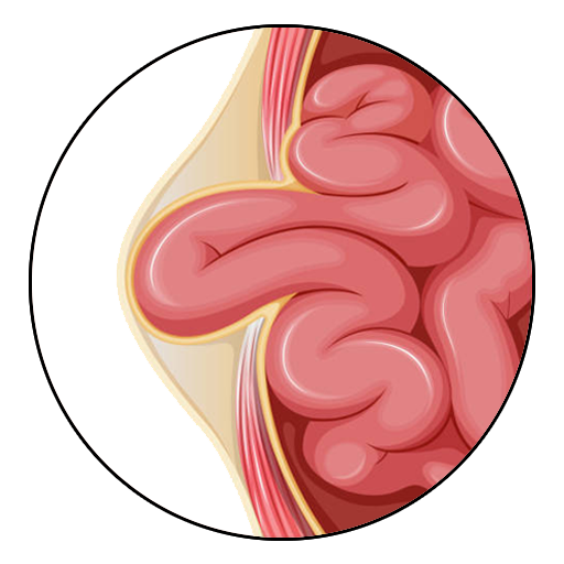 Hernia