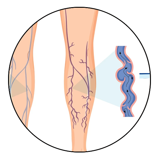 Varicose Veins